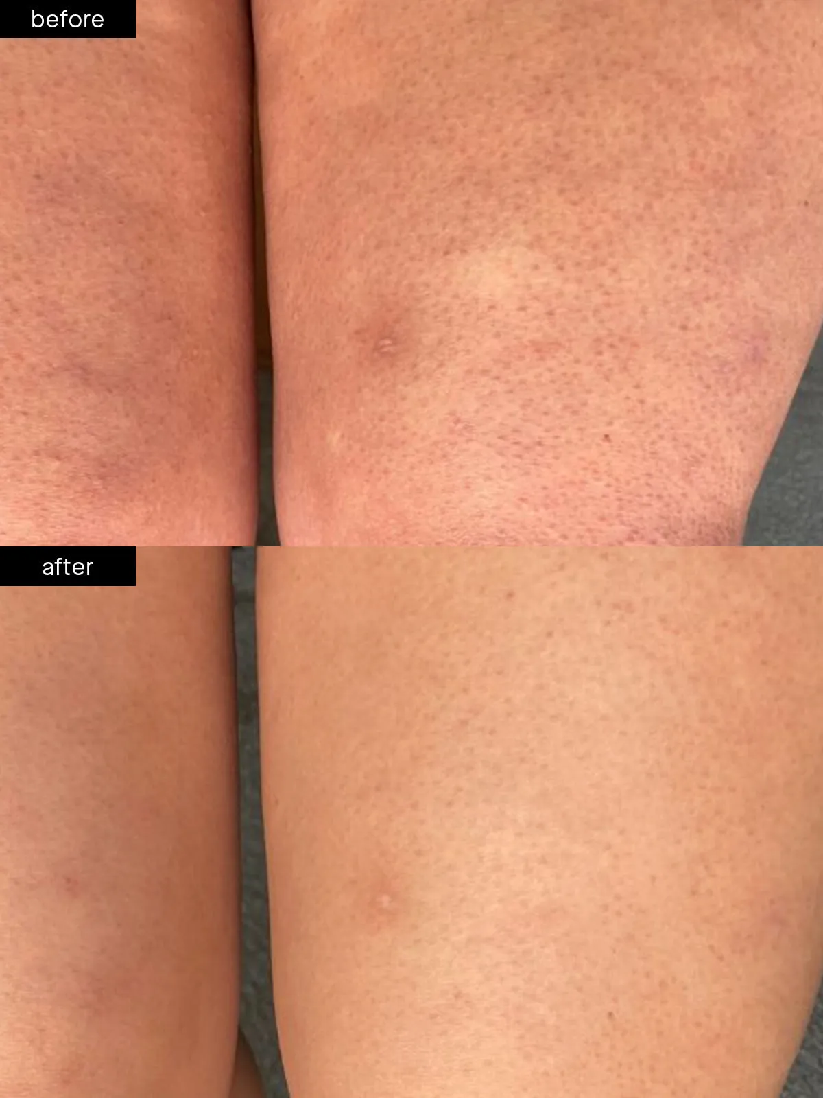 Body Smoothing System