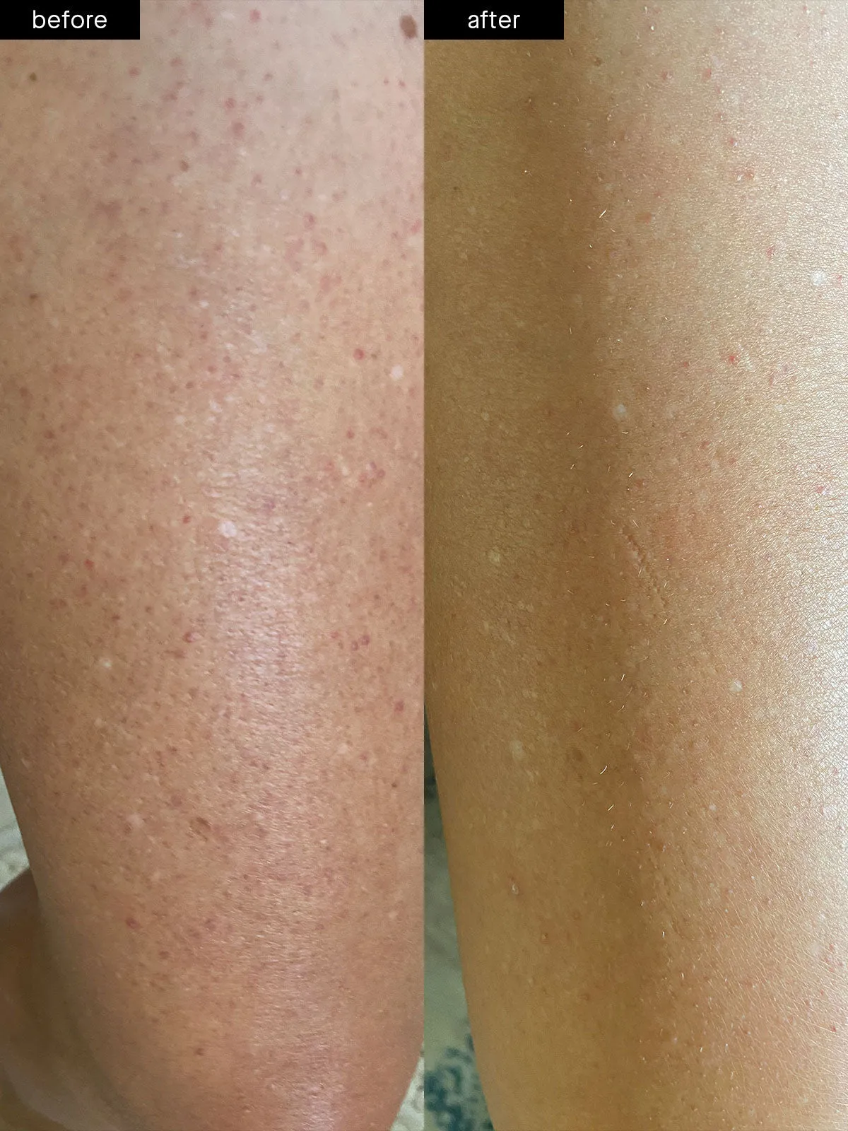 Body Smoothing System